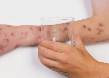 Менингококкт халдвараас хэрхэн урьдчилан сэргийлэх вэ