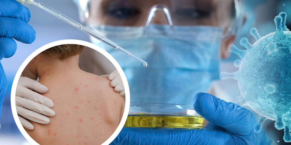 Сармагчны цэцэг өвчний үед ямар шинж тэмдгүүд илрэх вэ?