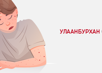 Улаанбурхан өвчний 11 дэх тохиолдол лабораториор батлагдлаа