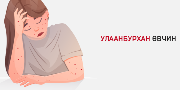 Улаанбурхан өвчний 11 дэх тохиолдол лабораториор батлагдлаа