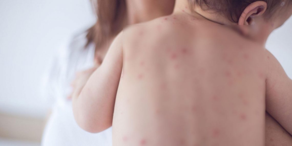 ХӨСҮТ: Улаанбурхан өвчний батлагдсан тохиолдол 3 нэмэгджээ