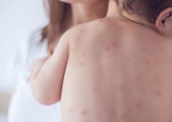 ХӨСҮТ: Улаанбурхан өвчний батлагдсан тохиолдол 3 нэмэгджээ